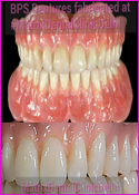 BPS Dentures fabricated at Matrix Dental Clinic Delhi