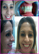 Cosmetic Smile Designing at Matrix Dental Clinic Delhi