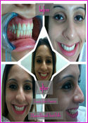 Cosmetic Smile Designing Before & After at Matrix Dental Clinic Delhi