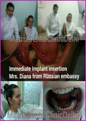  Immdediate Implant Insertion