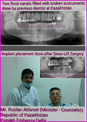 Implant Placement done after Sinus Lift Surgery