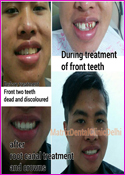 Before tereatment - Front two teeth dead and discoloured - After root canal treatment and crowns